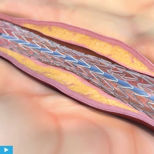 Stentbehandlung: Was ist ein Stent? Wie verläuft die OP?
